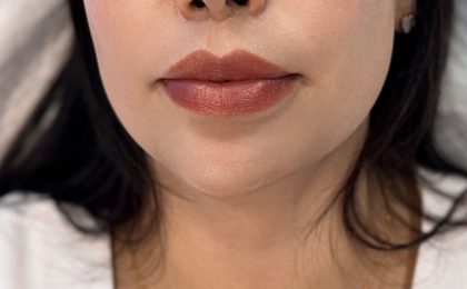 Chin Filler Before & After Patient #4225
