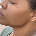 Jawline Filler Before & After Patient #4301