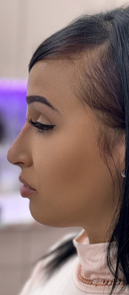 Liquid Rhinoplasty Before & After Patient #4310