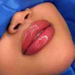 Russian Lips Before & After Patient #4331
