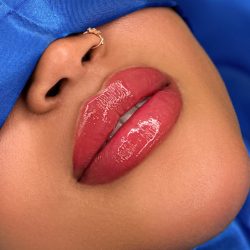Russian Lips Before & After Patient #4331