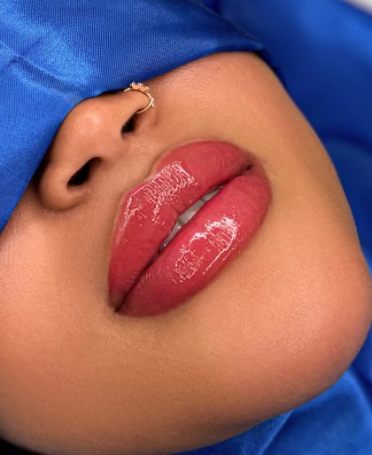 Russian Lips Before & After Patient #4331