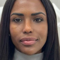 Fox Eye Threadlift Before & After Patient #4381