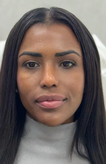 Fox Eye Threadlift Before & After Patient #4381