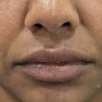 Smile Lines Treatment Before & After Patient #4385
