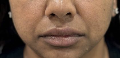 Smile Lines Treatment Before & After Patient #4385