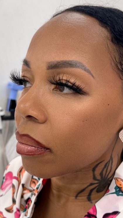 Fillers + Thread Lift Before & After Patient #4289
