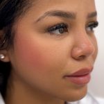Facial Balancing With Fillers Before & After Patient #4274
