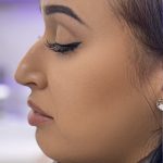 Liquid Rhinoplasty Before & After Patient #4310