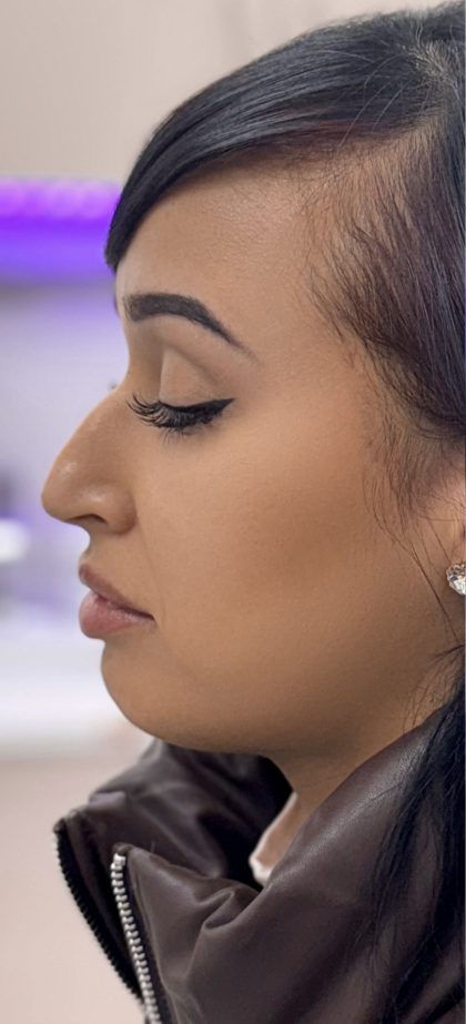 Liquid Rhinoplasty Before & After Patient #4310