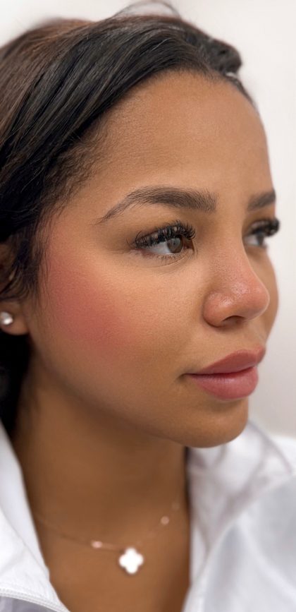 Facial Balancing With Fillers Before & After Patient #4274