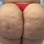 Aveli Cellulite Before & After Patient #4222
