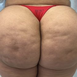 Aveli Cellulite Before & After Patient #4222