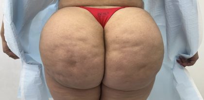 Aveli Cellulite Before & After Patient #4222
