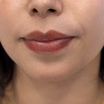 Chin Filler Before & After Patient #4225
