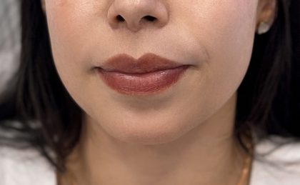 Chin Filler Before & After Patient #4225