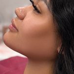 Chin Liposuction Before & After Patient #4265