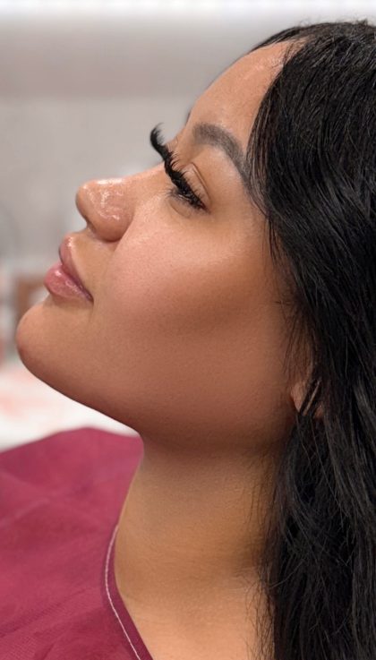 Chin Liposuction Before & After Patient #4265