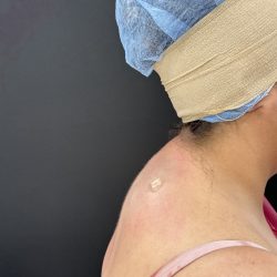 Buffalo Hump Liposuction Before & After Patient #4353