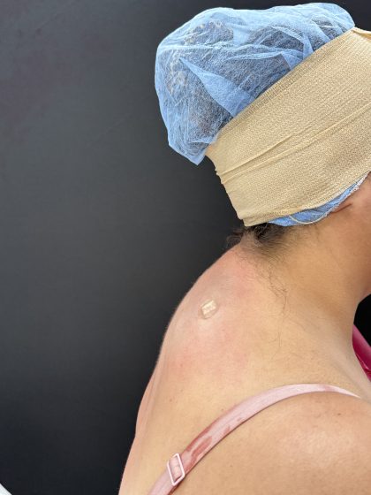 Buffalo Hump Liposuction Before & After Patient #4353