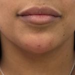 Chin Filler Before & After Patient #4359