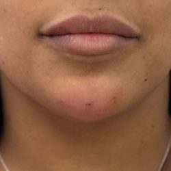Chin Filler Before & After Patient #4359