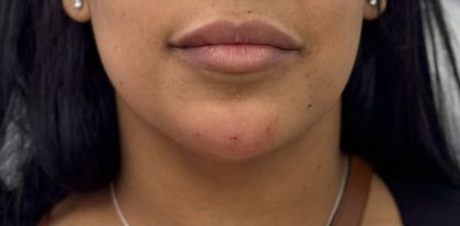 Chin Filler Before & After Patient #4359