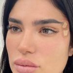 Fox Eye Threadlift Before & After Patient #4380