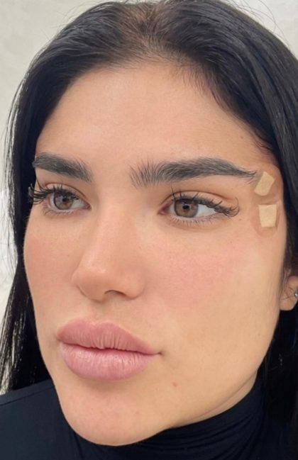 Fox Eye Threadlift Before & After Patient #4380