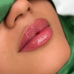 Russian Lips Before & After Patient #4388