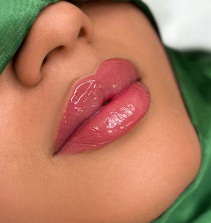 Russian Lips Before & After Patient #4388