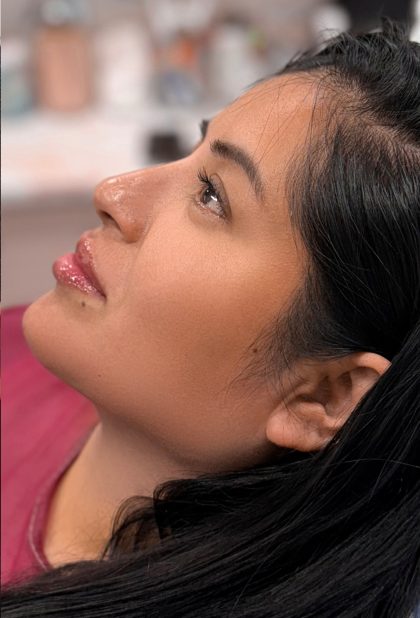 Chin Liposuction Before & After Patient #4234