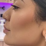 Jawline Filler Before & After Patient #4304