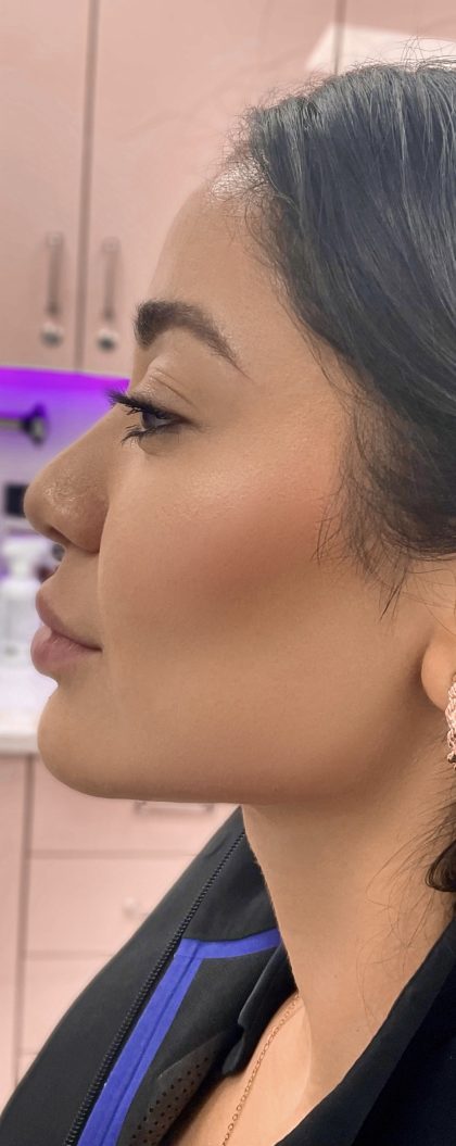 Jawline Filler Before & After Patient #4304