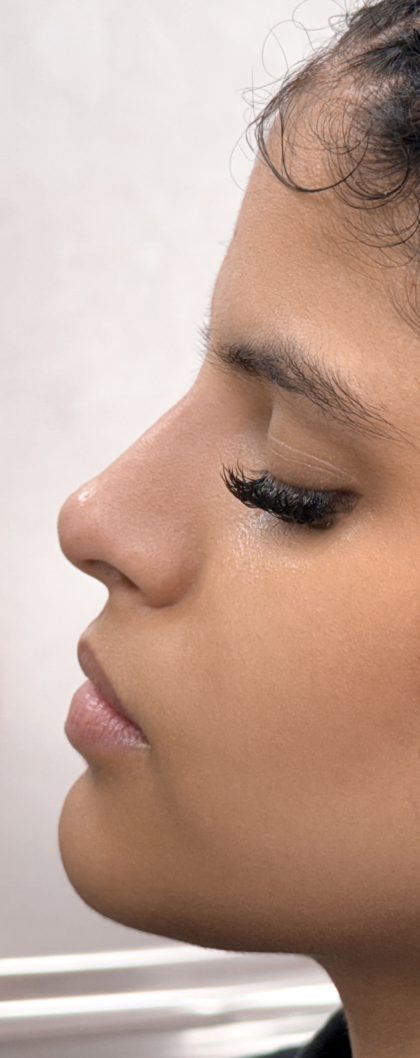 Liquid Rhinoplasty Before & After Patient #4313