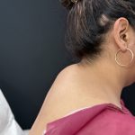 Buffalo Hump Liposuction Before & After Patient #4353