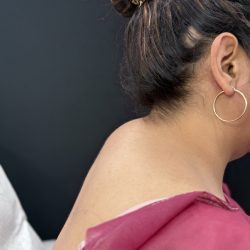 Buffalo Hump Liposuction Before & After Patient #4353