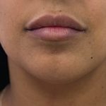 Chin Filler Before & After Patient #4359