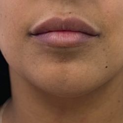 Chin Filler Before & After Patient #4359