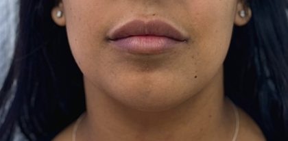 Chin Filler Before & After Patient #4359