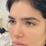 Fox Eye Threadlift Before & After Patient #4380
