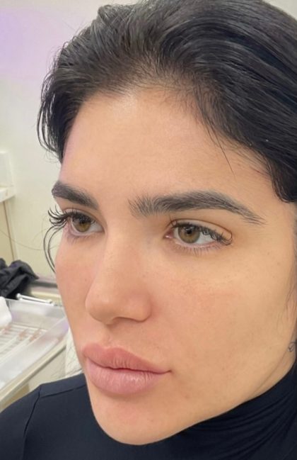 Fox Eye Threadlift Before & After Patient #4380