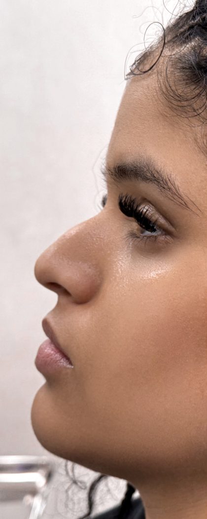 Liquid Rhinoplasty Before & After Patient #4313