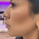 Jawline Filler Before & After Patient #4304