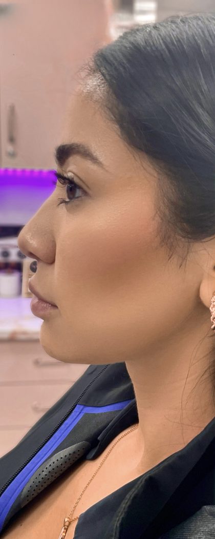 Jawline Filler Before & After Patient #4304