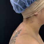 Buffalo Hump Removal Before & After Patient #4356