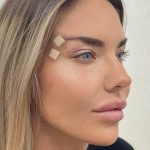 Fox Eye Threadlift Before & After Patient #4379