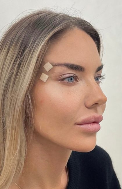 Fox Eye Threadlift Before & After Patient #4379