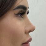 Liquid Rhinoplasty Before & After Patient #4382