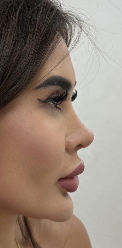 Liquid Rhinoplasty Before & After Patient #4382